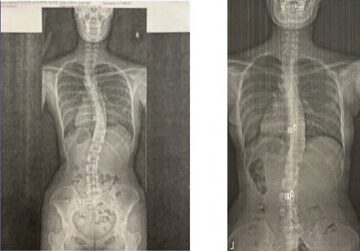 Scoliosis X-rays showing abnormal spinal curvature
